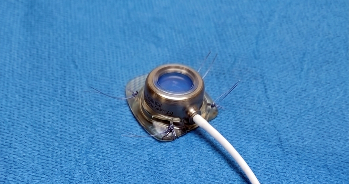 Bard PowerPort Catheter Lawsuit
